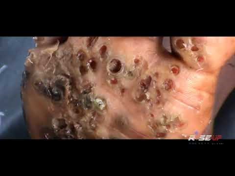 Cyrus (6) of Nasimbo many jiggers dug (1 of 6)