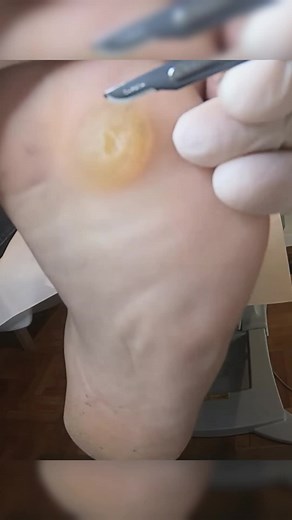 giant callus removal #blackheads #pimple #podiatry #podiatrist #footcare