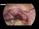 Laparoscopic Myomectomy for Posterior Wall Fibroid Uterus with Endometriosis  • Video • MEDtube.net