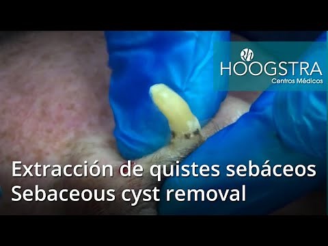 Sebaceous cyst removal (19013a)