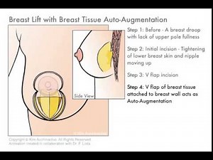 Breast Lift with Auto-Augmentation | Fat Transfer Augmentation | The Plastic Surgery Clinic
