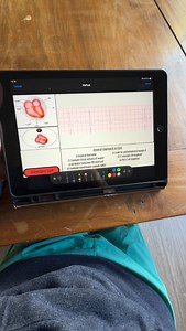 3.6K views · 257 reactions | Blocked PAC #ekg #ecg | ECG Lectures with Reid | Facebook