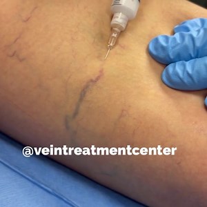 Foam Sclerotherapy of spider veins by Dr Hratch Karamanoukian....