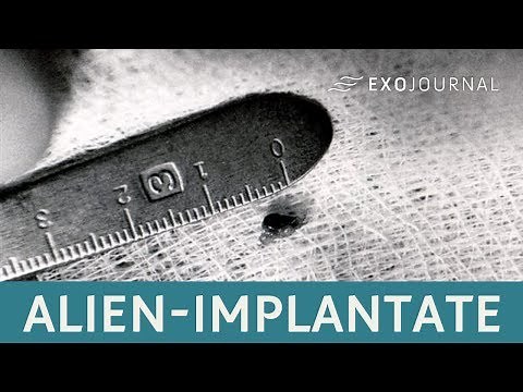 Alien-Implantate - Entführt von Außerirdischen? | ExoJournal