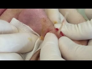 Squeezing pimple , cyst, boil!! Брызгающий Прыщ фурункул!!!