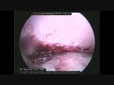 Laparoscopic Liver Abscess Drainage • Video • MEDtube.net