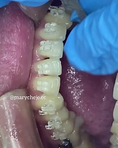 Stripping , interproximal reduction 🦷✨ Interproximal reduction is the practice of mechanically removing enamel from between the teeth to achieve orthodontic ends, such as to correct crowding, or reshape the contact area between neighboring teeth. . Case by @marycheje.ec | Dentistry blog