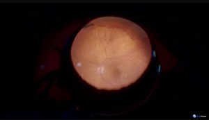 Asteroid Hyalosis with PDR - Eyetube