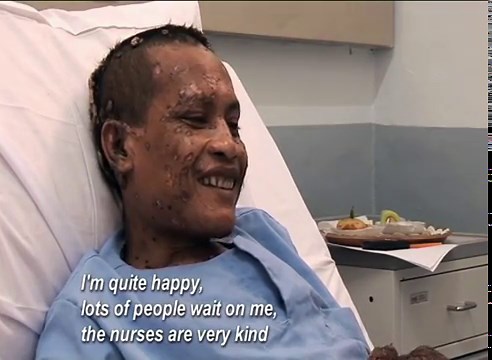 Tree-man disease: When humans turn into trees - Strange Sounds