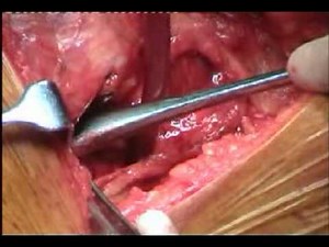 Birmingham Hip Resurfacing Surgery- Vijay Bose_Part 1