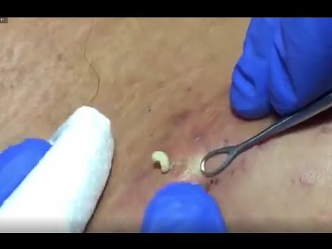 Blackheads in craters! Watch this! Original ASMR Pimple Video