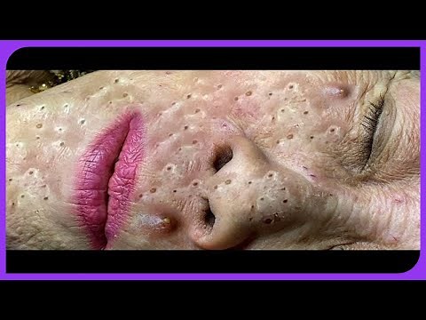 . Satisfying Blackheads Removal: Pimple Popping Blackheads On Skin 2024
