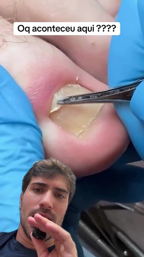ingrown toenail removal: what happened here?