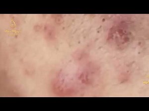 Loan Nguyen Acne Treatment 335pre