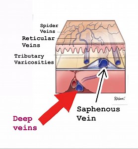 Spider veins, reticular veins, varicose veins, saphenous vein, deep veins. Venous #anatomy | Vein Treatment Center | Facebook