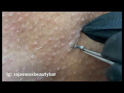 Ingrown hair removal #4