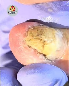 Smart Ways to Maintain Overgrown Toenails For All-Day Relief #SafeNailCare #ThickToenailCare #NailFixTips #HomeNailCare | Evgeniy