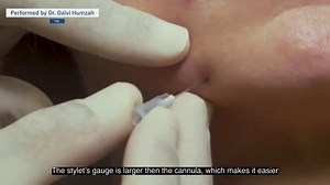 TSK Steriglide Dermal Filling Cannulas - Box of 20