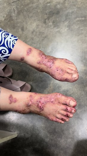 Understanding Fungal Skin Infections: Causes and Treatment