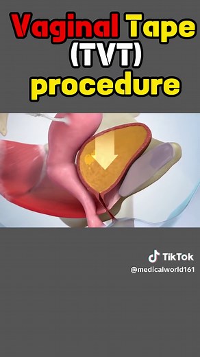 Vaginal Tape (TVT) Procedure #valorant #tap #tvt #procedure #treatment #3danimation #watch #foryou #foryourpage