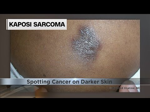 How to spot melanoma and other cancers on darker skin