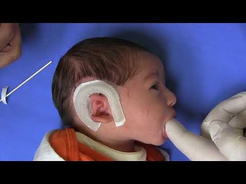 Cup Ear Infant Ear Deformity Corrected with EarWell® Infant Ear Deformity Correction Device
