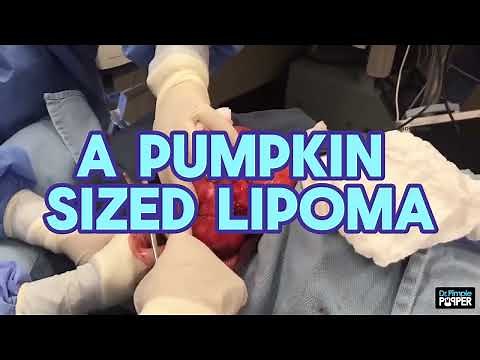 This Huge Lipoma Shocked Me! | Can Dr. Pimple Popper Get This Lipoma Out!?