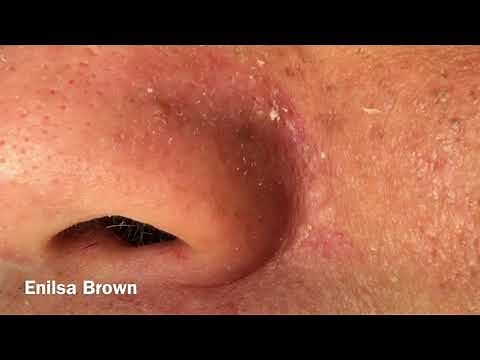 The ultimate extractions of the Nose and More on Daryl