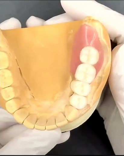 Convoluted Precision Attachment Denture‪@cbdentallab6893‬
