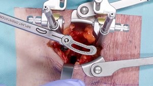Treatment Options in Minimally Invasive Degenerative Spine Surgery - Part 5/6: Minimally Invasive TLIF Device Placement and Rod Management