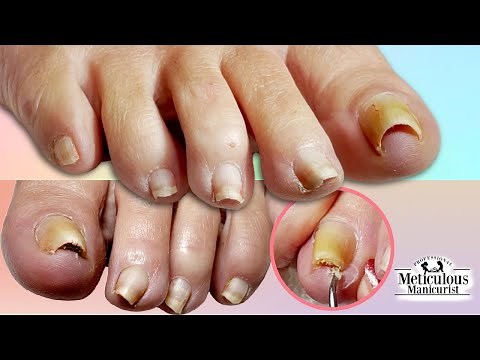 Pedicure Relief on Pincer INGROWN Toenail that Hurts