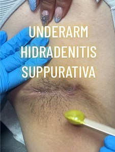 3.7M views · 8.9K reactions | HS UNDERARM WAX using Lemon Kiss by @sexysmoothwax  #wax #foryoupage #hs #educational #fyp #reels #waxing #estheticianlife #hidradenitissuppurativa #underarmwax #reelsfacebook #fblifestyle | Waxing Queen | Facebook