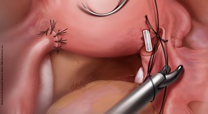 Laparoscopic Essure tubal reversal: How we do it | Contemporary OB/GYN