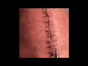 How to Remove Surgical Staples from Total Knee Replacement