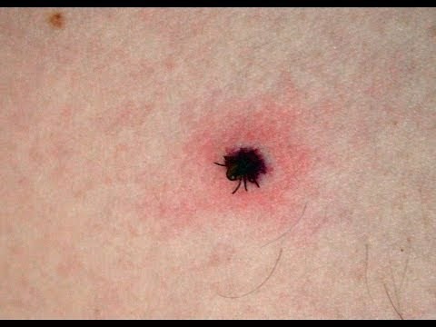 How to Remove a Tick [DermTV.com Epi #512]