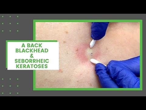 A Back Blackhead & Seborrheic Keratoses | Dr. Derm