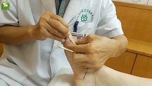 14K views · 150 reactions | Acupuncture for spinous process of C7 avulsion fracture for one year, neck and back pain by Dr. Zhong Shiyuan. | Qihuang Healthcare | Facebook