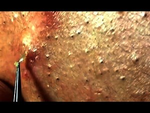 Blackhead Squeezed Pimple Removal