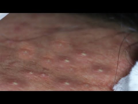 Amazing Cysts and Blackheads! Daily Video Relaxing with Sophia Skin Care #05