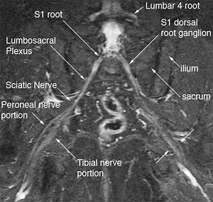 Magnetic resonance neurography - Alchetron, the free social encyclopedia
