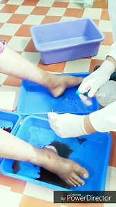 Fasad therapy for varicose vein | Al-Shifa Hijama Clinic