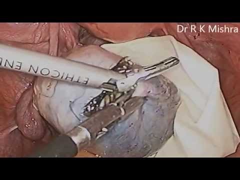 Laparoscopic Dermoid Ovarian Cystectomy by Dr R K Mishra