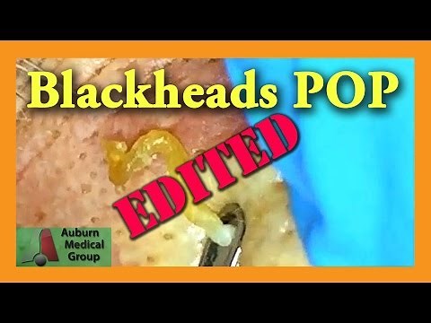 Blackheads POP! EDITED | Auburn Medical Group