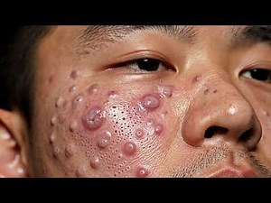 Blackhead ASMR Therapy | Relaxing Skincare Session