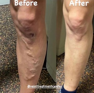 Images for BEFORE and AFTER microphlebectomy for painful varicose veins. @veintreatmentcenter on IG www.VeinsVeinsVeins.com 716-839-3638 | Vein Treatment Center | Facebook