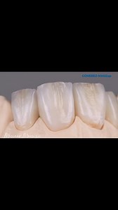 COVERED MAKEup in Vienna, Austria 🇦🇹 @ivoclar Thank you very much for this beautiful days!!!! #emax #veneers #emaxcrown #ceramics #zahn #zahnarztpraxis #zahnarzt #zahnmedizin #zahntechniker | Mariano Maurizi