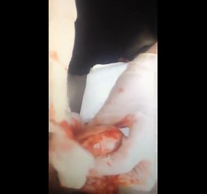 Femdom cuts open sac and castrates first testicle