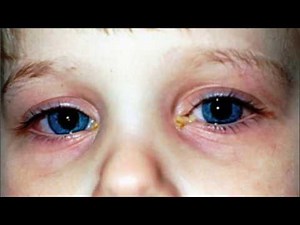 Difference Between Viral and Bacterial Pink Eye