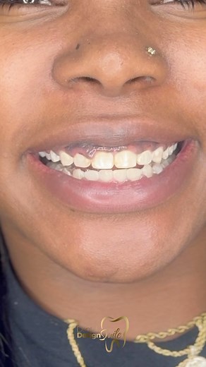 29K views · 22 reactions | Composite resin, known for its natural appearance and durability, allows us to correct imperfections in your teeth, such as stains, cracks, or unwanted spaces. With skill and precision, we will sculpt each tooth to achieve perfect harmony with your face and personality. | Dental Design Smile | Facebook