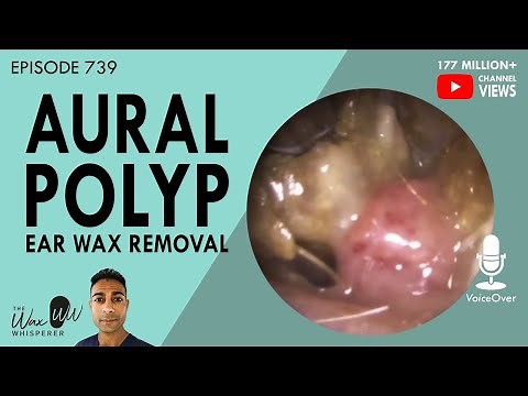 739 - Infected Aural Polyp Ear Wax Removal